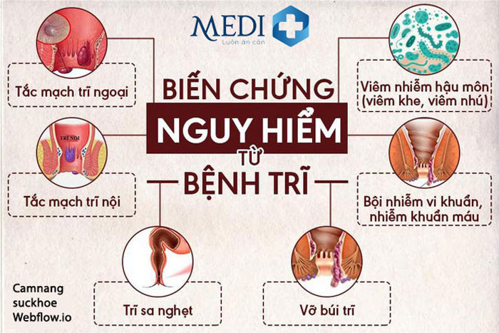Biến chứng của hình ảnh bị trĩ khi mang thai nếu không điều trị