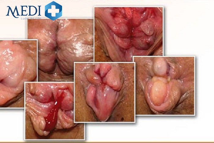 Tổng quan các hình ảnh bị trĩ khi mang thai qua các giai đoạn