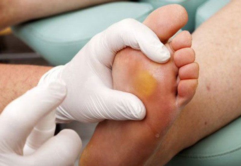 Người không mang tất khi đi giày dễ bị chai chân